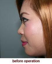 plastic_surgery_augmentation_rhinoplasty